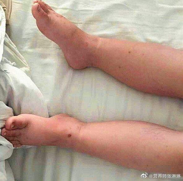 中医如何通过调理饮食解决浮肿问题