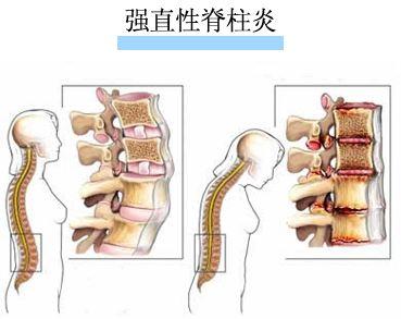 强直性脊柱炎被拒绝入职