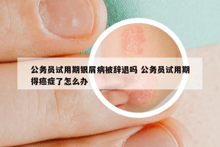 银屑病对公务员体检的影响，探讨与解析